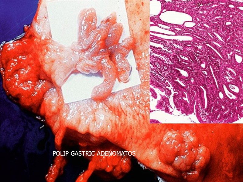 POLIP GASTRIC ADENOMATOS